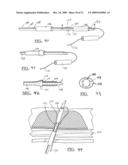 Method and Apparatus for Coupling Soft Tissue to a Bone diagram and image