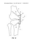 IMPLANTABLE BRACE FOR PROVIDING JOINT SUPPORT diagram and image