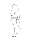 IMPLANTABLE BRACE FOR PROVIDING JOINT SUPPORT diagram and image