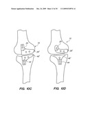 IMPLANTABLE BRACE FOR PROVIDING JOINT SUPPORT diagram and image