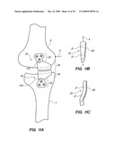 IMPLANTABLE BRACE FOR PROVIDING JOINT SUPPORT diagram and image