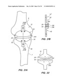 IMPLANTABLE BRACE FOR PROVIDING JOINT SUPPORT diagram and image