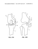 IMPLANTABLE BRACE FOR PROVIDING JOINT SUPPORT diagram and image