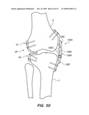 IMPLANTABLE BRACE FOR PROVIDING JOINT SUPPORT diagram and image