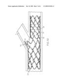 Stent with Protruding Branch Portion for Bifurcated Vessels diagram and image