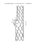 Stent with Protruding Branch Portion for Bifurcated Vessels diagram and image