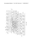 Stent with Protruding Branch Portion for Bifurcated Vessels diagram and image