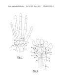 Method and Apparatus for Wrist Arthroplasty diagram and image