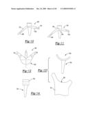 Method and Apparatus for Wrist Arthroplasty diagram and image