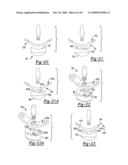 Method and Apparatus for Wrist Arthroplasty diagram and image