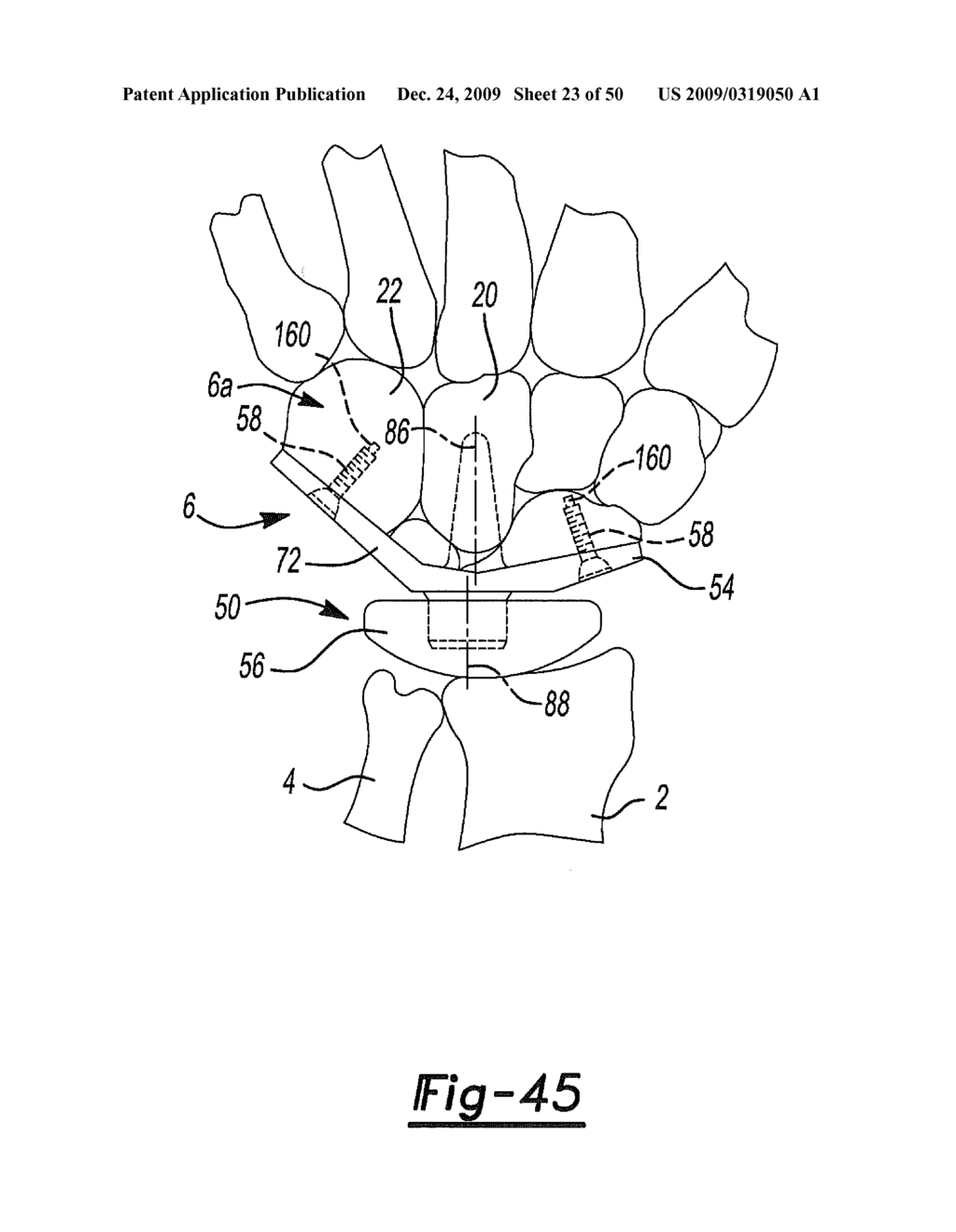 Method and Apparatus for Wrist Arthroplasty - diagram, schematic, and image 24