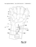 Method and Apparatus for Wrist Arthroplasty diagram and image