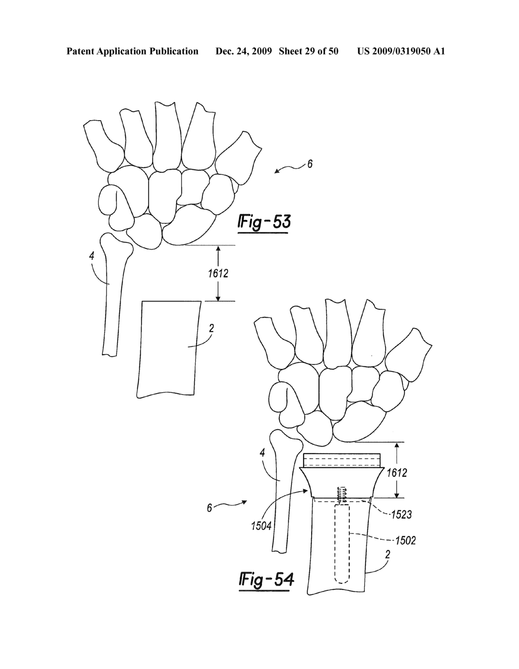 Method and Apparatus for Wrist Arthroplasty - diagram, schematic, and image 30