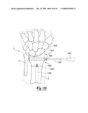 Method and Apparatus for Wrist Arthroplasty diagram and image