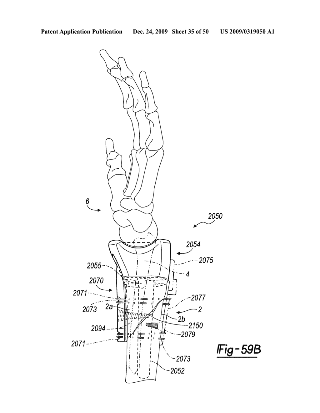 Method and Apparatus for Wrist Arthroplasty - diagram, schematic, and image 36