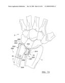 Method and Apparatus for Wrist Arthroplasty diagram and image