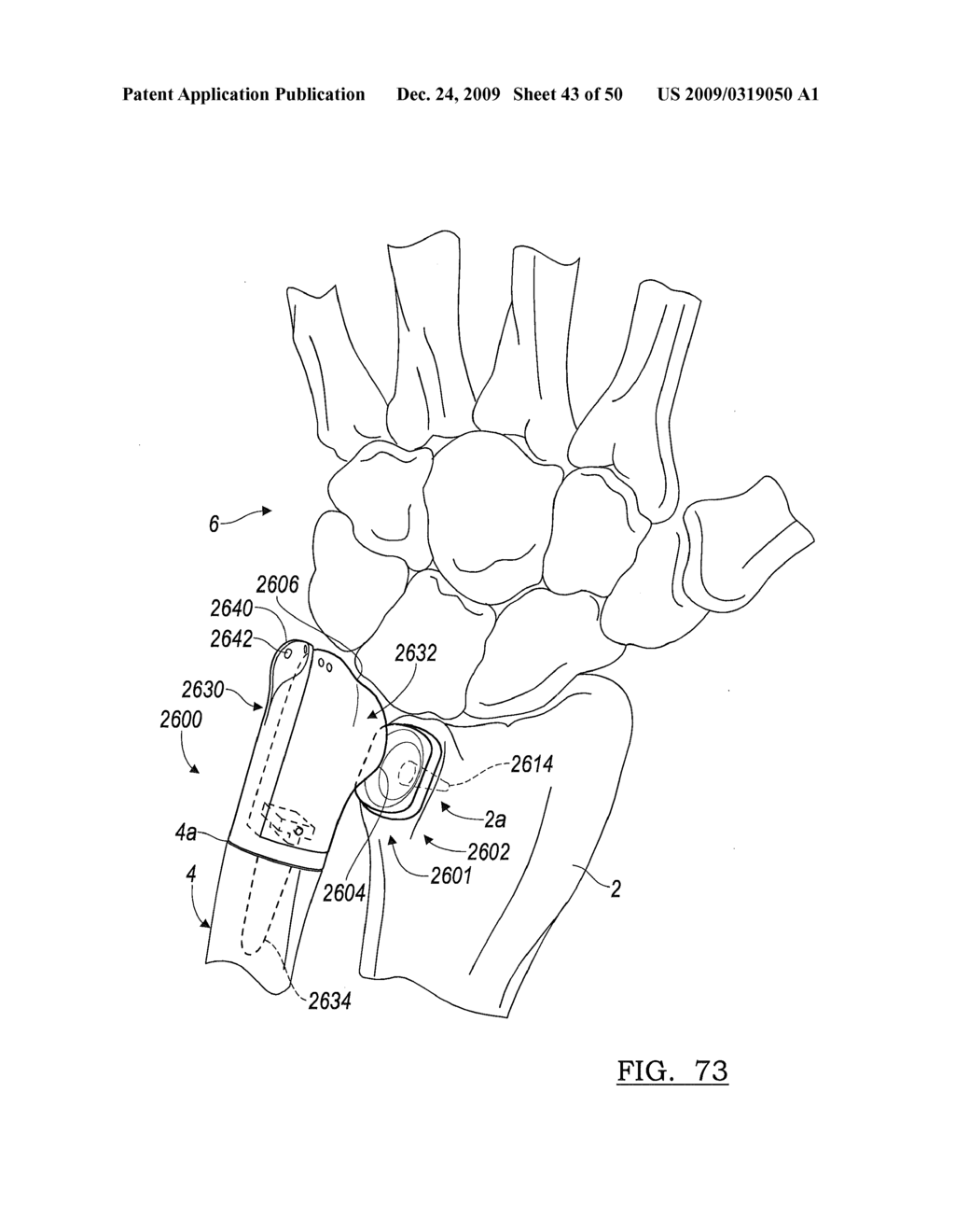 Method and Apparatus for Wrist Arthroplasty - diagram, schematic, and image 44