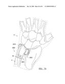 Method and Apparatus for Wrist Arthroplasty diagram and image