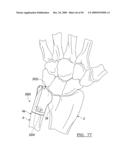 Method and Apparatus for Wrist Arthroplasty diagram and image