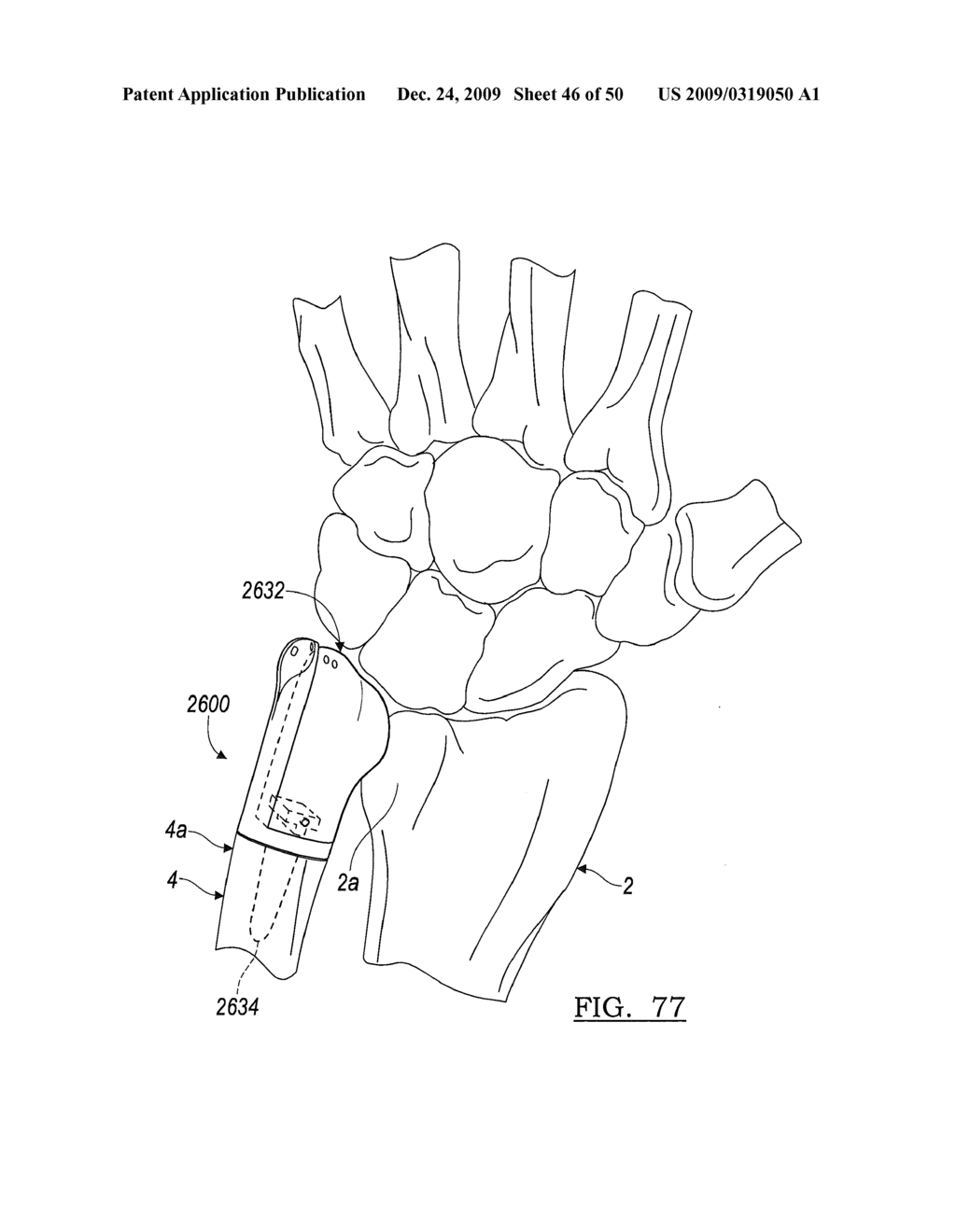 Method and Apparatus for Wrist Arthroplasty - diagram, schematic, and image 47