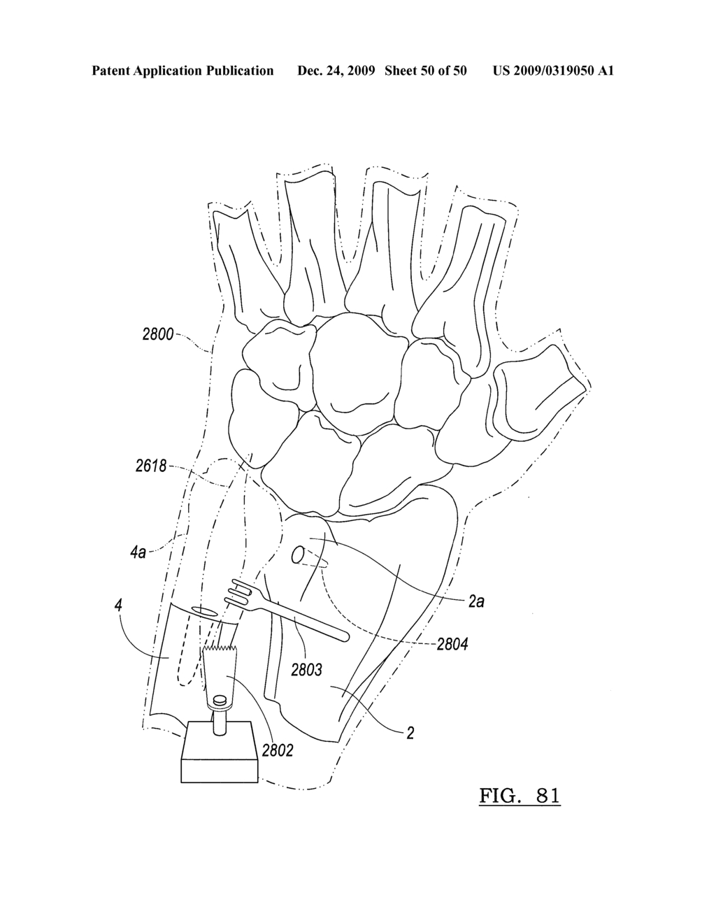 Method and Apparatus for Wrist Arthroplasty - diagram, schematic, and image 51