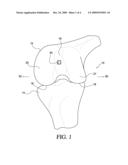 OSTEOCHONDRAL PLUG GRAFT, KIT AND METHOD diagram and image