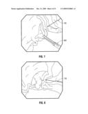 Methods For The Placement Of Sutures In Tissue diagram and image