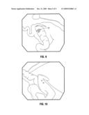 Methods For The Placement Of Sutures In Tissue diagram and image