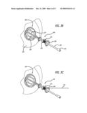 BRACHYTHERAPY APPARATUS FOR ASYMMETRICAL BODY CAVITIES diagram and image