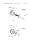 BRACHYTHERAPY APPARATUS FOR ASYMMETRICAL BODY CAVITIES diagram and image