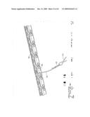 IMPLANTABLE DEVICE FOR THE TREATMENT OF OBESITY diagram and image