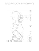 IMPLANTABLE DEVICE FOR THE TREATMENT OF OBESITY diagram and image