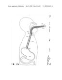 IMPLANTABLE DEVICE FOR THE TREATMENT OF OBESITY diagram and image