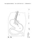 IMPLANTABLE DEVICE FOR THE TREATMENT OF OBESITY diagram and image