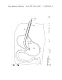 IMPLANTABLE DEVICE FOR THE TREATMENT OF OBESITY diagram and image