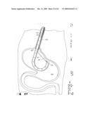 IMPLANTABLE DEVICE FOR THE TREATMENT OF OBESITY diagram and image