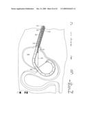 IMPLANTABLE DEVICE FOR THE TREATMENT OF OBESITY diagram and image