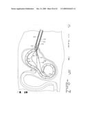 IMPLANTABLE DEVICE FOR THE TREATMENT OF OBESITY diagram and image