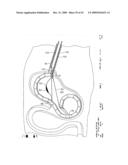 IMPLANTABLE DEVICE FOR THE TREATMENT OF OBESITY diagram and image