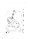 IMPLANTABLE DEVICE FOR THE TREATMENT OF OBESITY diagram and image