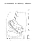 IMPLANTABLE DEVICE FOR THE TREATMENT OF OBESITY diagram and image