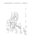 IMPLANTABLE DEVICE FOR THE TREATMENT OF OBESITY diagram and image