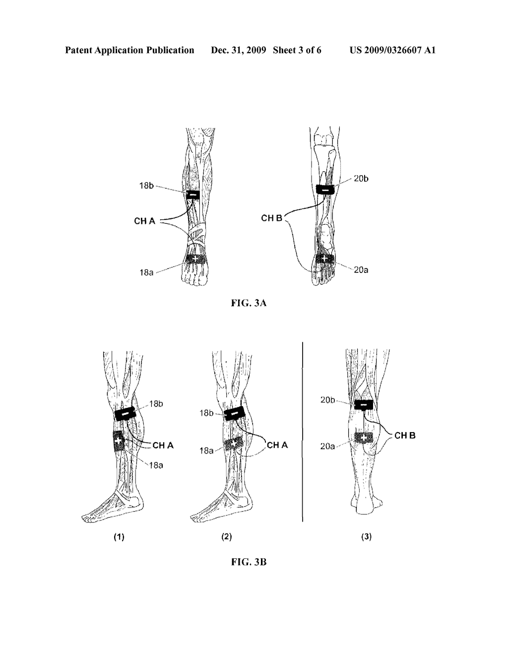 Electrical Stimulation Method for Treatment of Peripheral Neuropathy - diagram, schematic, and image 04