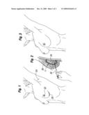 FILLABLE PROSTHETIC IMPLANT WITH GEL-LIKE PROPERTIES diagram and image
