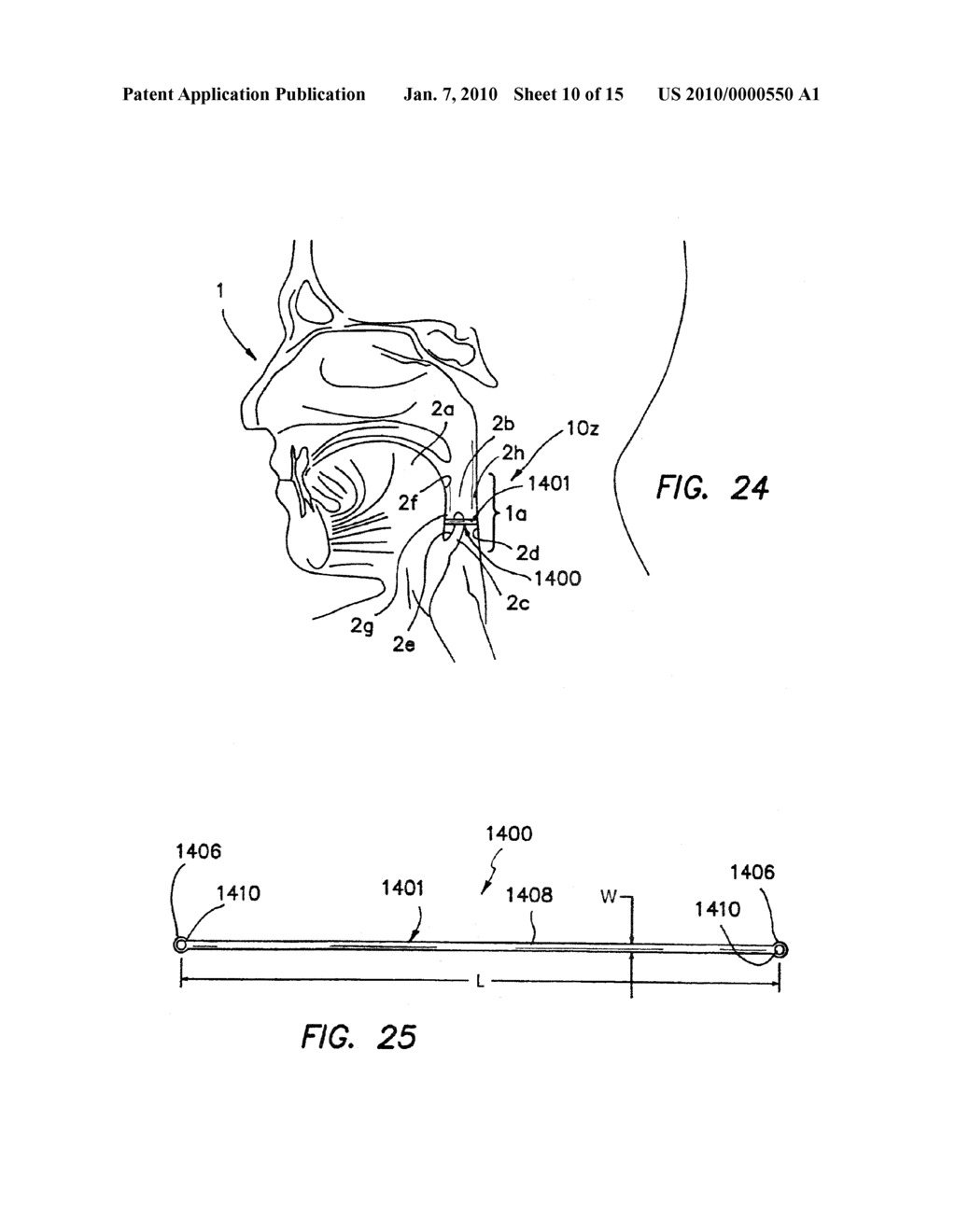 APPARATUS AND METHODS FOR TREATING SLEEP APNEA - diagram, schematic, and image 11