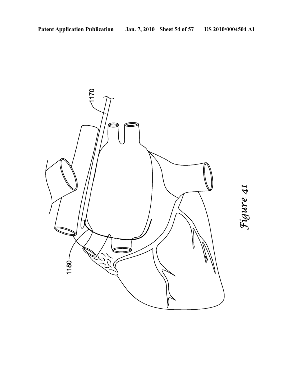 EPICARDIAL CLIP - diagram, schematic, and image 55