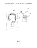 Method and Apparatus for Foreign Matter Detection For Blood Content Sensors diagram and image