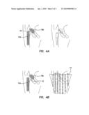 Apparatus and Method for In Vivo Intracellular Transfection of Gene, SIRNA, SHRNA Vectors, and Other Biomedical Diagnostic and Therapeutic Drugs and Molecules for the Treatment of Arthritis and Other Orthopedic Diseases in Large Animals and Humans diagram and image