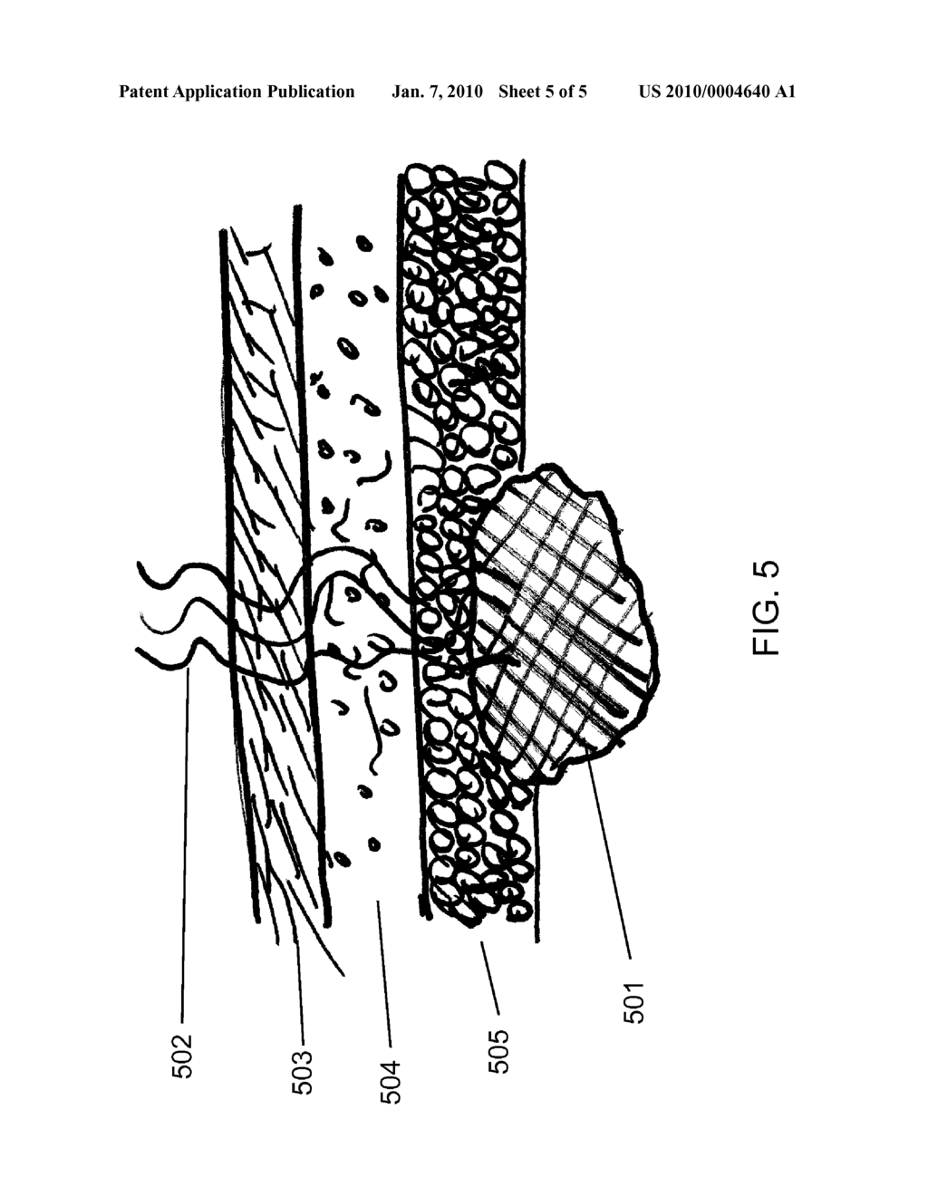 Cancer Treatment Using Lasers - diagram, schematic, and image 06