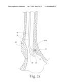 Method to treat gastric reflux via the detection and ablation of gastro-esophageal nerves and receptors diagram and image